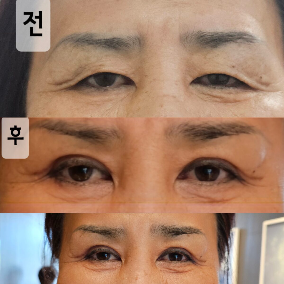 ศัลยกรรมตกแต่งเปลือกตาบน (ผู้อำนวยการใหญ่ โด ออน-รก)