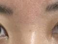 การผ่าตัดแก้ไขสายตาของผู้กำกับโด ออน-รก
