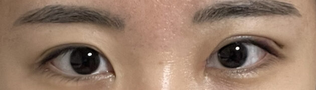 การผ่าตัดแก้ไขสายตาของผู้กำกับโด ออน-รก