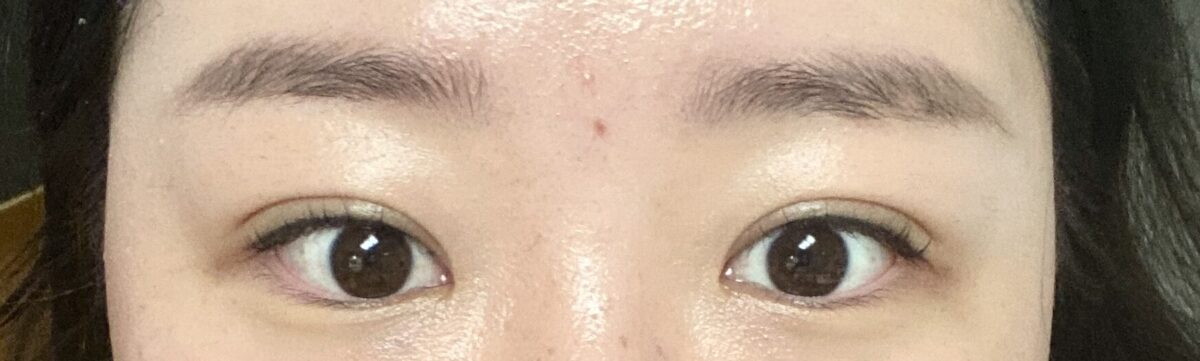 ยกกระชับเปลือกตาบนแบบไม่ผ่าตัด +