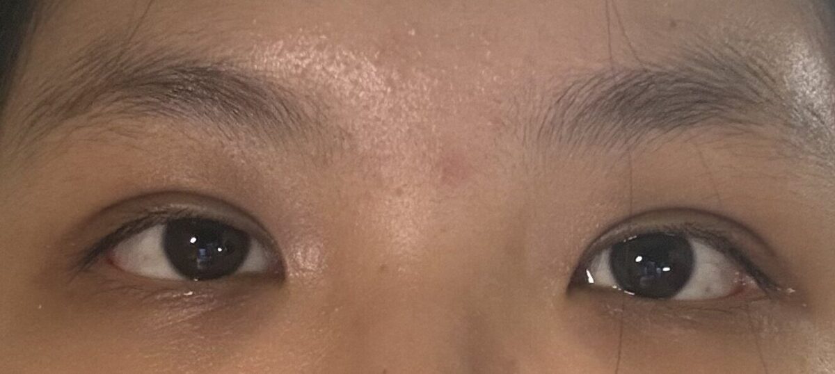 รีวิวการผ่าตัดทำตาสองชั้น