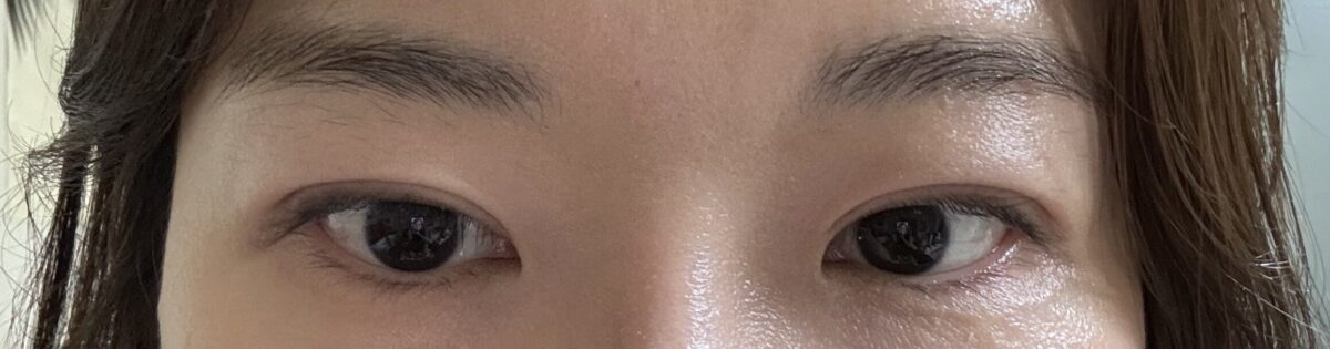 都彦禄院长  全切双眼皮   术后反馈
