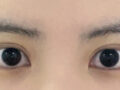 都彦禄医生双眼皮手术+开上眼角一个半月后的复查