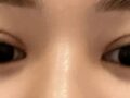 การผ่าตัดแก้ไขสายตาของผู้กำกับโด ออน-รก