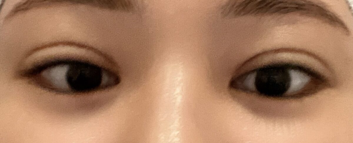 การผ่าตัดแก้ไขสายตาของผู้กำกับโด ออน-รก