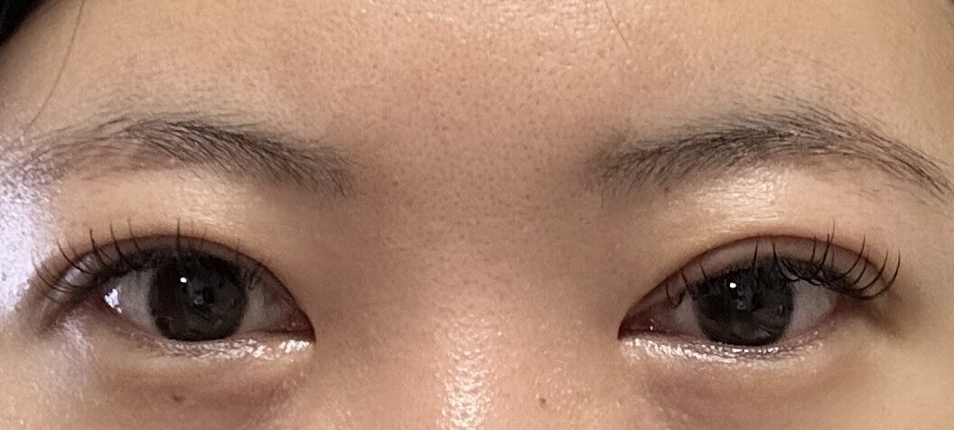 รีวิวการผ่าตัดแก้ไขรอยแผลและการแก้ไขเปลือกตาโดย ดร.โด ออน-รก