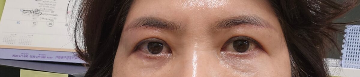 眉毛巨像術と目下脂肪再配置手術