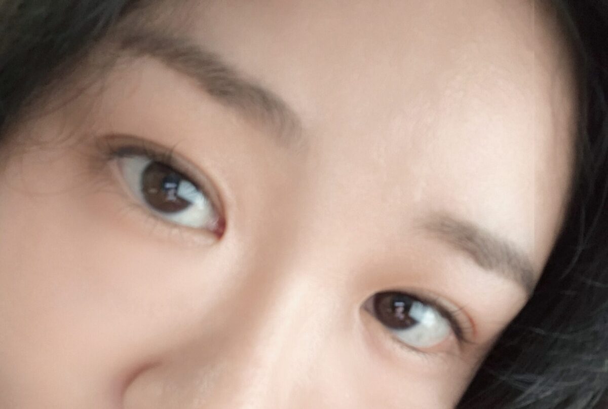 ผู้กำกับโด ออน-ร็อก - ศัลยกรรมแก้ไขสายตา