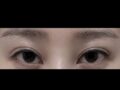 การทบทวนผลการสอบซ้ำหลังการผ่าตัด