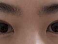 รีวิวการผ่าตัดทำตาสองชั้น