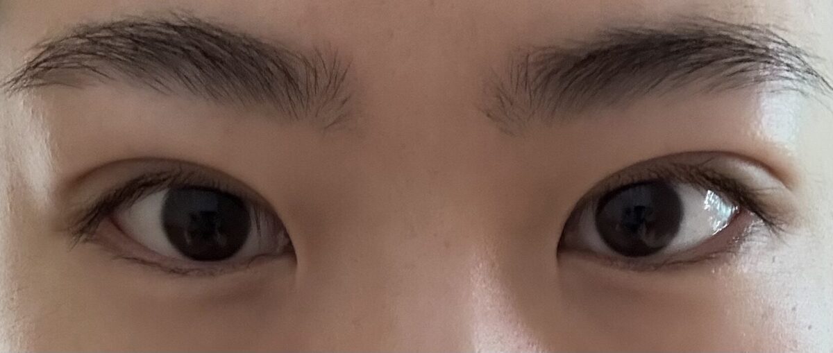 รีวิวการผ่าตัดทำตาสองชั้น