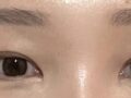ฉันเข้ารับการผ่าตัดแก้ไขทำตาสองชั้น (เย็บซ่อนไหม) โดยศัลยแพทย์คิม ฮงจิน