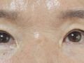 นี่คือบทวิจารณ์ขั้นตอนการผ่าตัดเสริมเปลือกตาบนด้วยวิธีธรรมชาติ ซึ่งดำเนินการโดยผู้อำนวยการคิม ฮงจิน