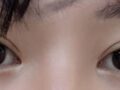 2 เดือนหลังจากการผ่าตัดแก้ไขสายตาของ ดร.โด ออน-รก