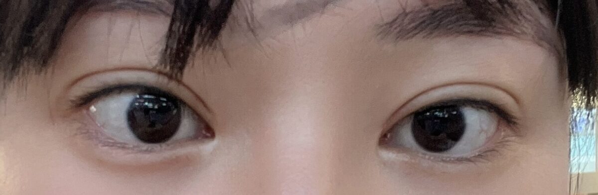 2 เดือนหลังจากการผ่าตัดแก้ไขสายตาของ ดร.โด ออน-รก