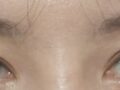 รีวิวการผ่าตัดแก้ไขสายตาของ ดร.โด ออน-รก