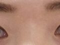 การแก้ไขสายตา