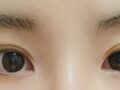 ฉันเข้ารับการผ่าตัดแก้ไขหนังตาสองชั้นแบบกรีด และการผ่าตัดตกแต่งหัวตา โดยผู้กำกับนา ยองซู!!
