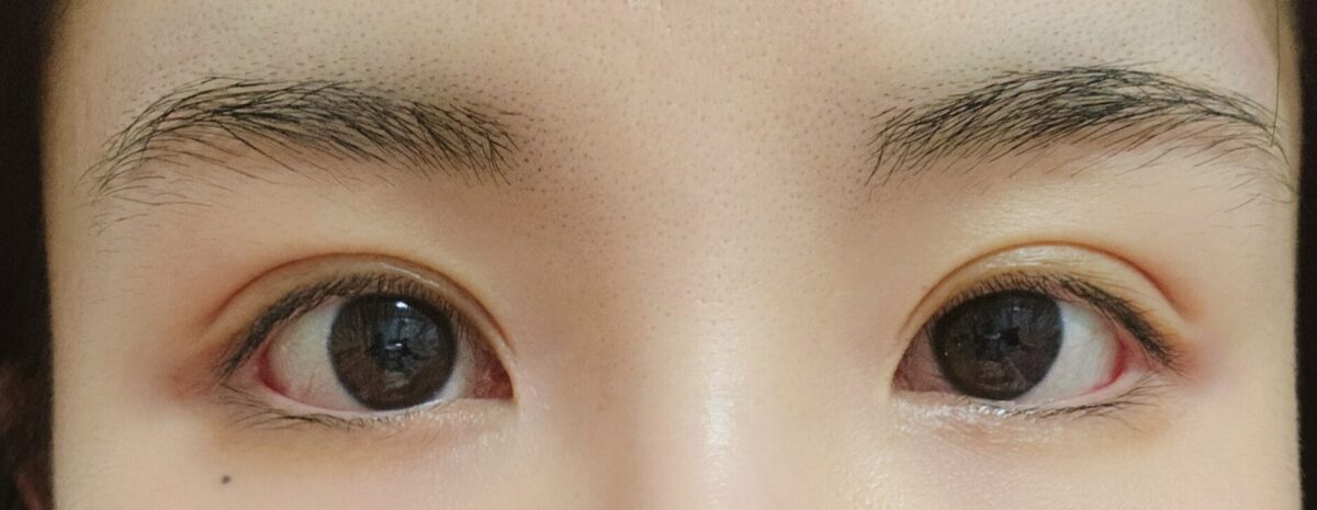 ฉันเข้ารับการผ่าตัดแก้ไขหนังตาสองชั้นแบบกรีด และการผ่าตัดตกแต่งหัวตา โดยผู้กำกับนา ยองซู!!