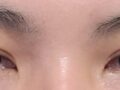 รีวิวการรักษาด้วยวิธี Natural Adhesion Treatment หลัง 2 เดือน โดยผู้กำกับ โด ออน-ร็อก