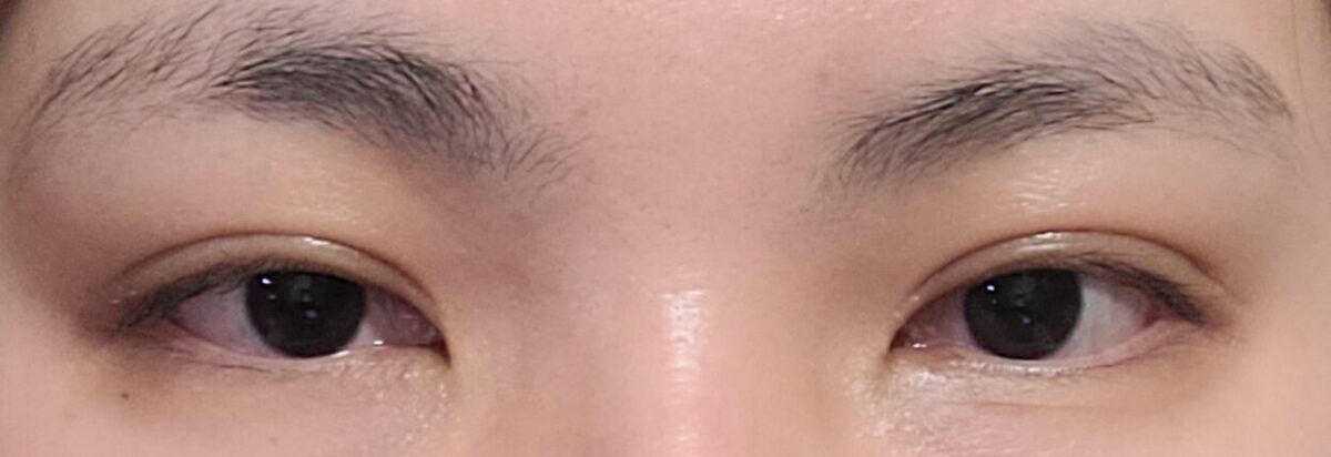 รีวิวการรักษาด้วยวิธี Natural Adhesion Treatment หลัง 2 เดือน โดยผู้กำกับ โด ออน-ร็อก