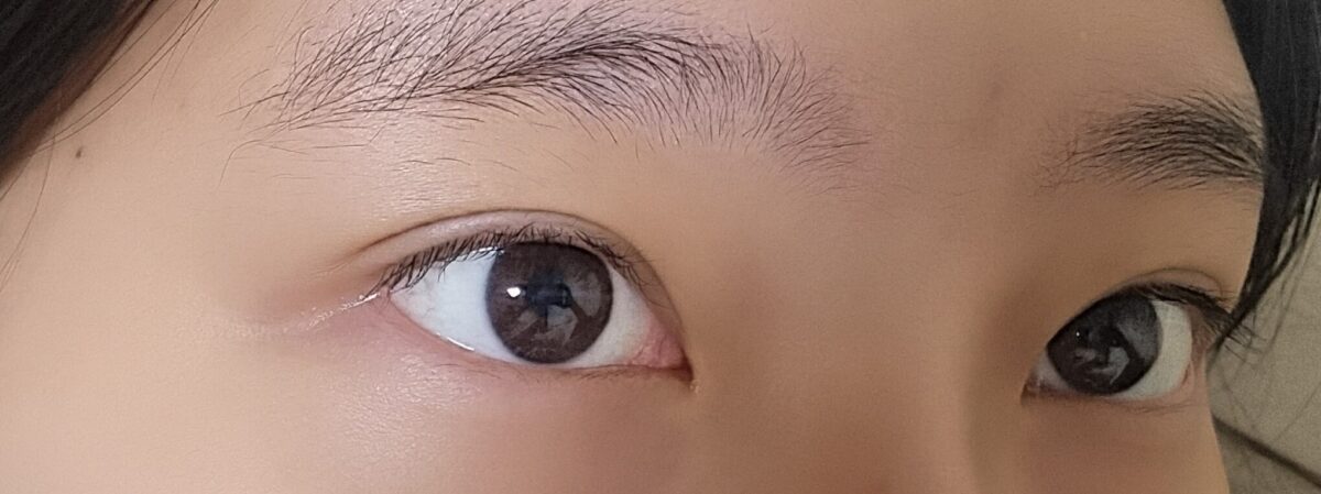 รีวิวการผ่าตัดทำตาสองชั้นแบบไม่ต้องกรีดของ ดร. คิม ฮงจิน ที่คลินิกอิลมิริ