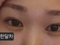 นี่คือรีวิวเกี่ยวกับการผ่าตัดแก้ไขภาวะพังผืดเกาะติดตามธรรมชาติที่ฉันได้รับจากผู้อำนวยการนา ยองซู