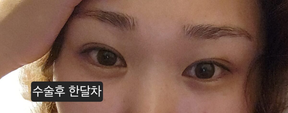 นี่คือรีวิวเกี่ยวกับการผ่าตัดแก้ไขภาวะพังผืดเกาะติดตามธรรมชาติที่ฉันได้รับจากผู้อำนวยการนา ยองซู