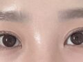 都彦禄院长   双眼皮修复
