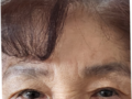 รีวิวการผ่าตัดทำตาสองชั้นแบบไม่ต้องกรีดแผลในผู้หญิงอายุ 75 ปี