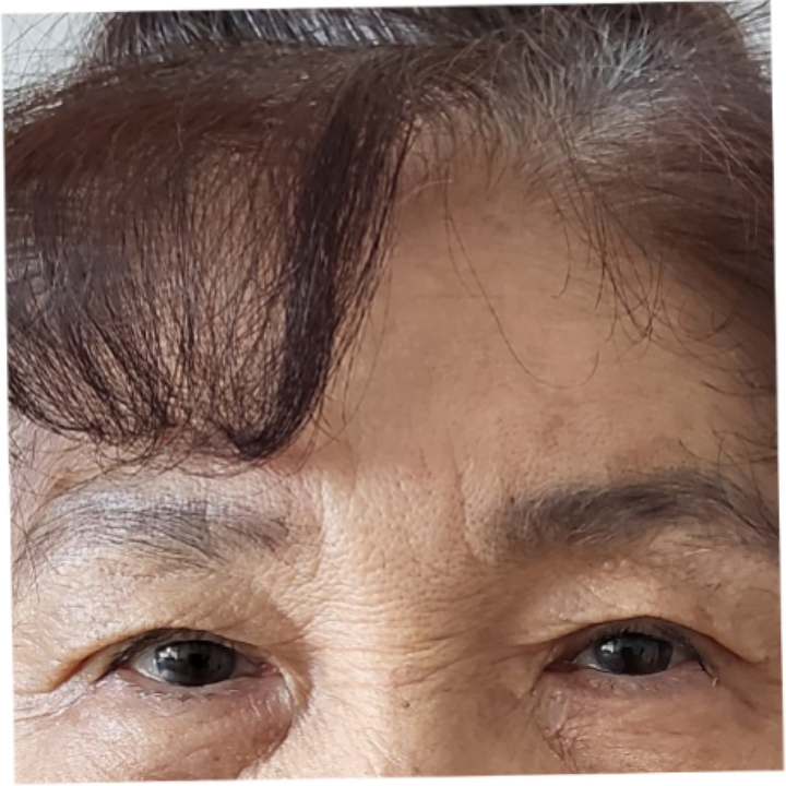 รีวิวการผ่าตัดทำตาสองชั้นแบบไม่ต้องกรีดแผลในผู้หญิงอายุ 75 ปี