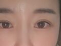 การยึดเกาะตามธรรมชาติ การยกเปลือกตาบน