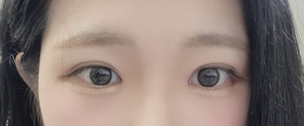 双眼皮修复（全切）、上眼角内眼角（修复）和提肌后记