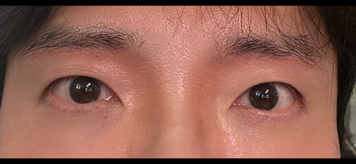 キム・ホンジン院長は眉毛の下の巨像手術の後期です。