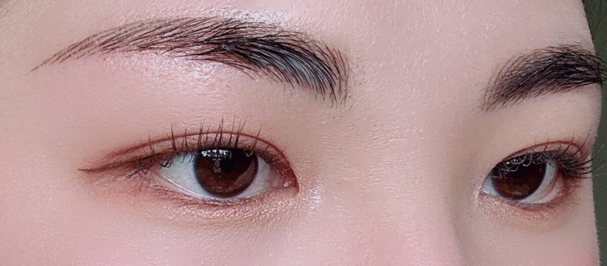การผ่าตัดตา