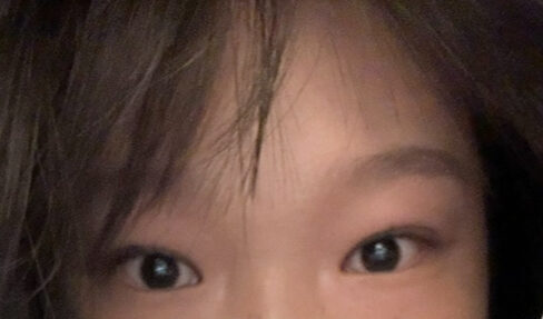 รีวิวการผ่าตัดยกกระชับเปลือกตาบนและการทำศัลยกรรมตกแต่งเปลือกตาสองชั้นของ ดร. นา ยองซู