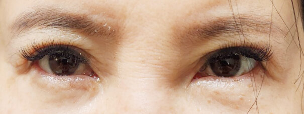 การจัดตำแหน่งไขมันใต้ตาใหม่ โดยหัวหน้าศัลยแพทย์ โด ออน-ร็อก ที่ 1mm Plastic Surgery