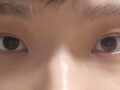 นี่คือผลการตรวจติดตามผลการแก้ไขเปลือกตาโดยไม่ต้องผ่าตัด หลังจากผ่านไปสองเดือน