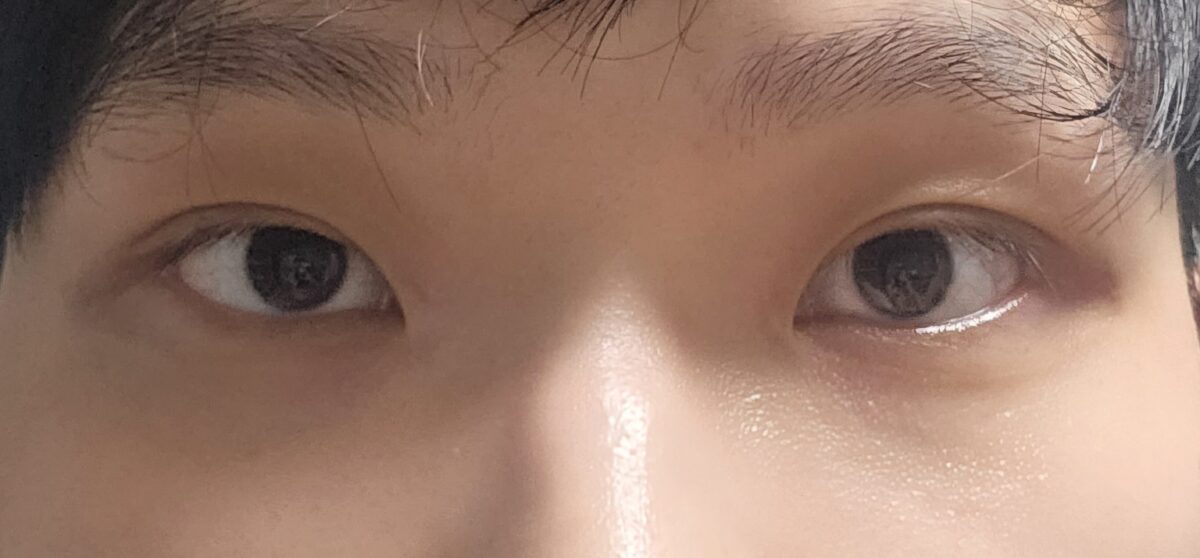 นี่คือผลการตรวจติดตามผลการแก้ไขเปลือกตาโดยไม่ต้องผ่าตัด หลังจากผ่านไปสองเดือน