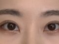 รีวิวการผ่าตัดทำตาสองชั้นของ ดร.คิม ฮงจิน