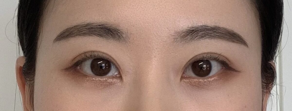รีวิวการผ่าตัดทำตาสองชั้นของ ดร.คิม ฮงจิน