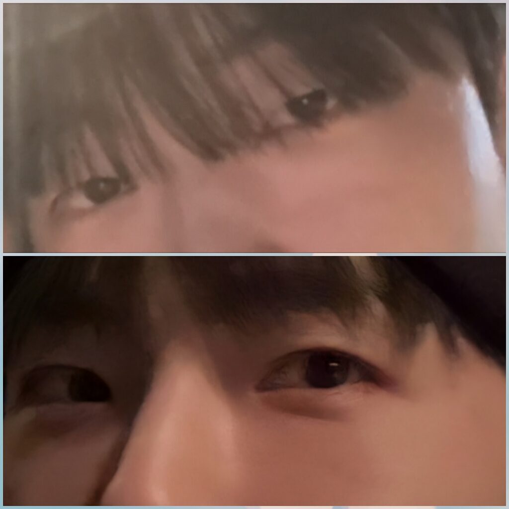 รีวิวการผ่าตัดแก้ไขเปลือกตาและจัดตำแหน่งไขมันใต้ตาใหม่