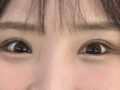 รีวิวการผ่าตัดตาซ้ำ