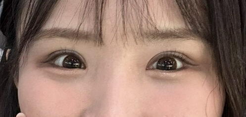 รีวิวการผ่าตัดตาซ้ำ