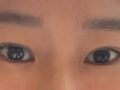 รีวิวการผ่าตัดแก้ไขเปลือกตาสองชั้นด้วยแผลผ่าตัดขนาด 1 มม.