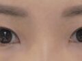 การผ่าตัดแก้ไขโดยไม่ต้องกรีดแผลของ ดร.คิม ฮงจิน