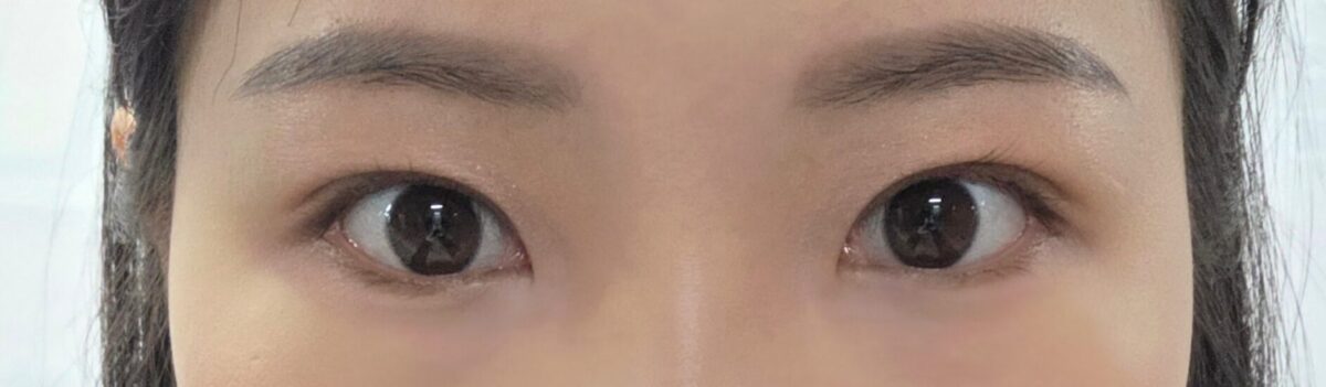 การผ่าตัดแก้ไขโดยไม่ต้องกรีดแผลของ ดร.คิม ฮงจิน