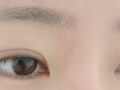 การผ่าตัดแก้ไขสายตาโดย ดร.คิม ฮงจิน ที่โรงพยาบาลอิลมิริ