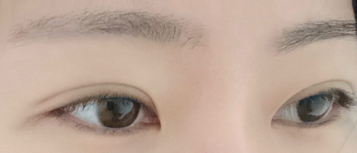 การผ่าตัดแก้ไขสายตาโดย ดร.คิม ฮงจิน ที่โรงพยาบาลอิลมิริ