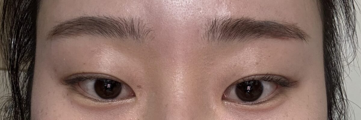 การยึดติดตามธรรมชาติ + การผ่าตัดตกแต่งหัวตา โดยผู้กำกับ โด ออน-ร็อก